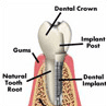 Dental Implant